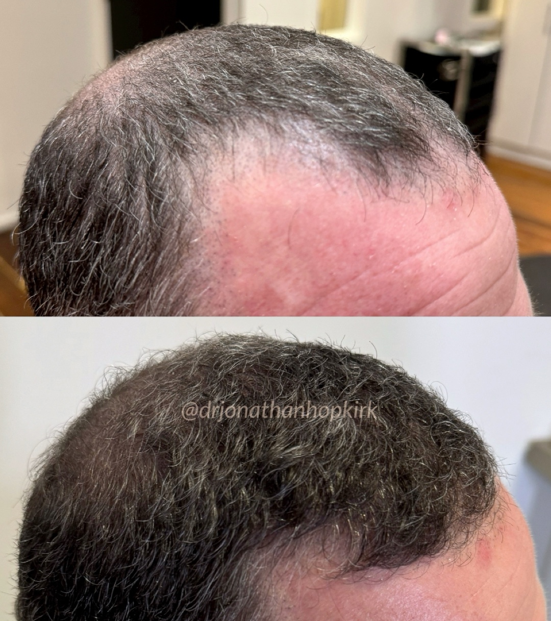 HRP™ Hair Restoration Protocol - HRP™ is at the leading edge of non-invasive solutions for hair restoration in all patients with mild to moderate hair loss.
