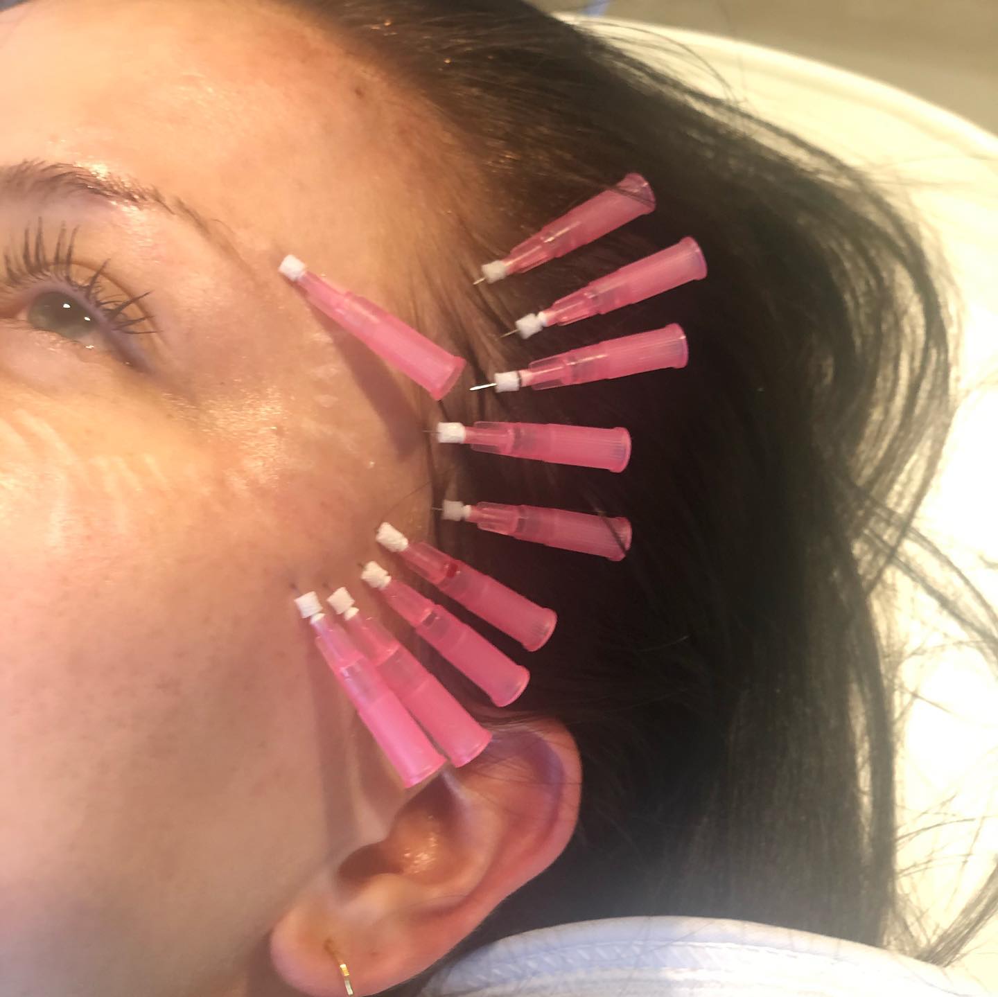 PDO Threads - Advanced non-surgical lifting treatment using dissolvable PDO threads to lift and tighten sagging skin while stimulating natural collagen production for long-lasting rejuvenation.